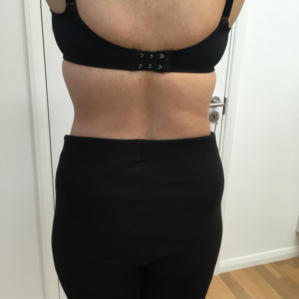 back-lipo-after