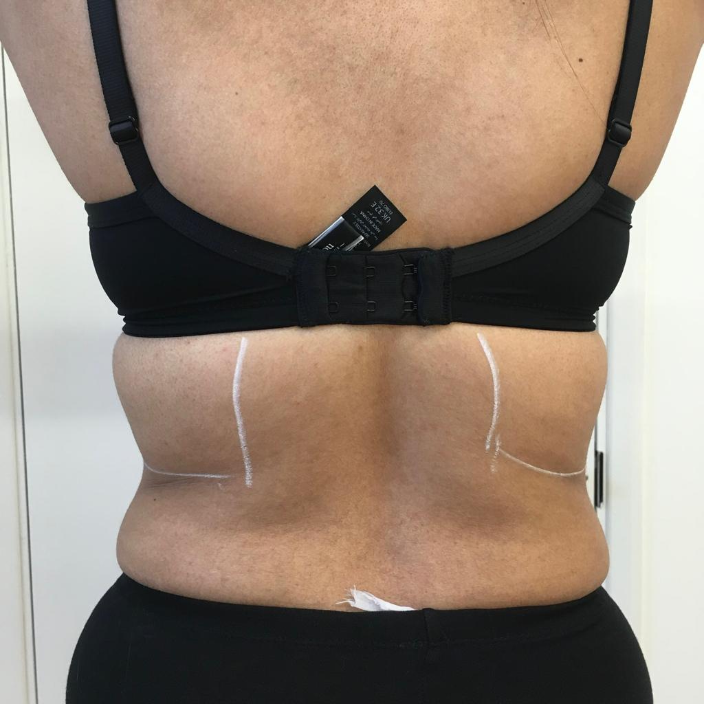 back-lipo