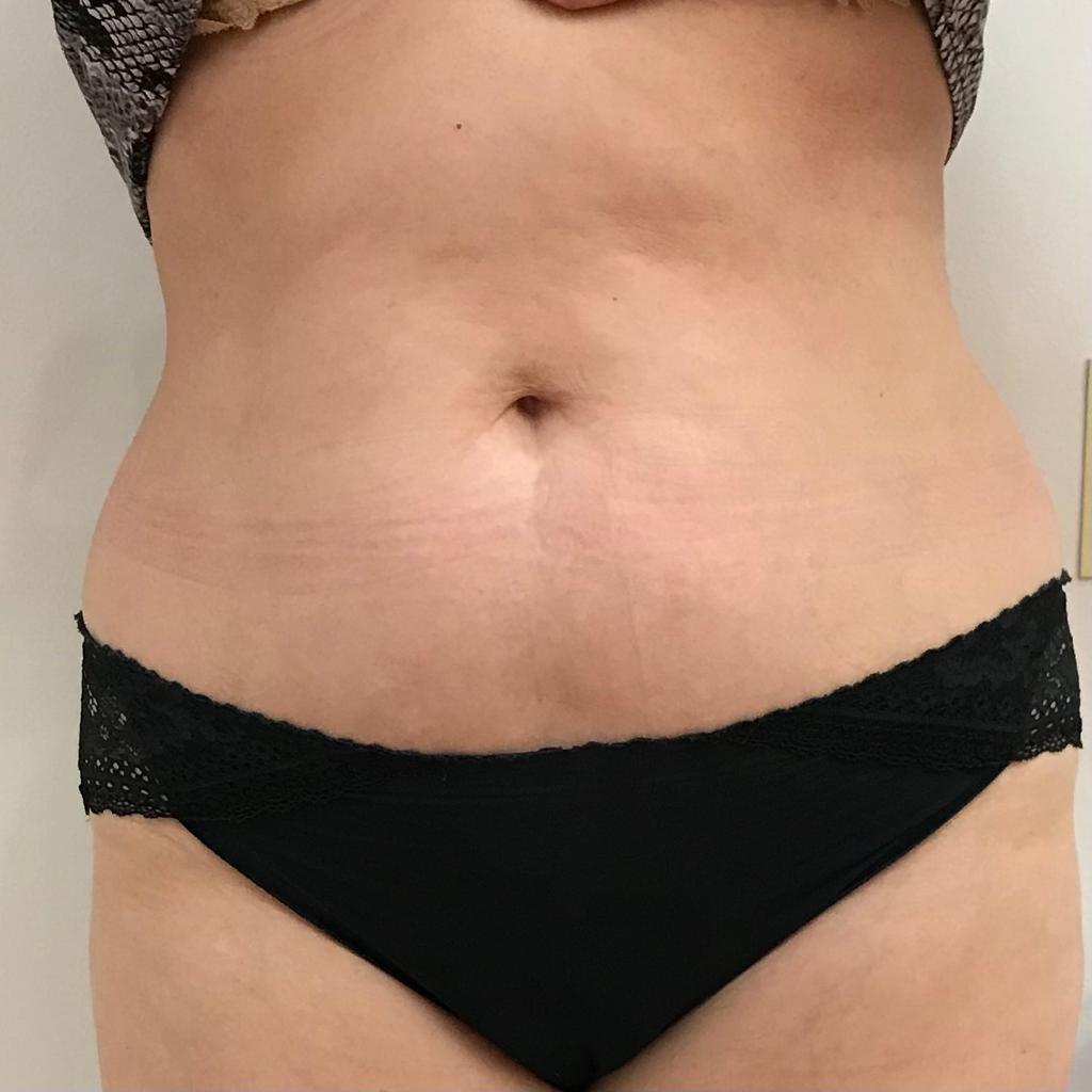 lipo after