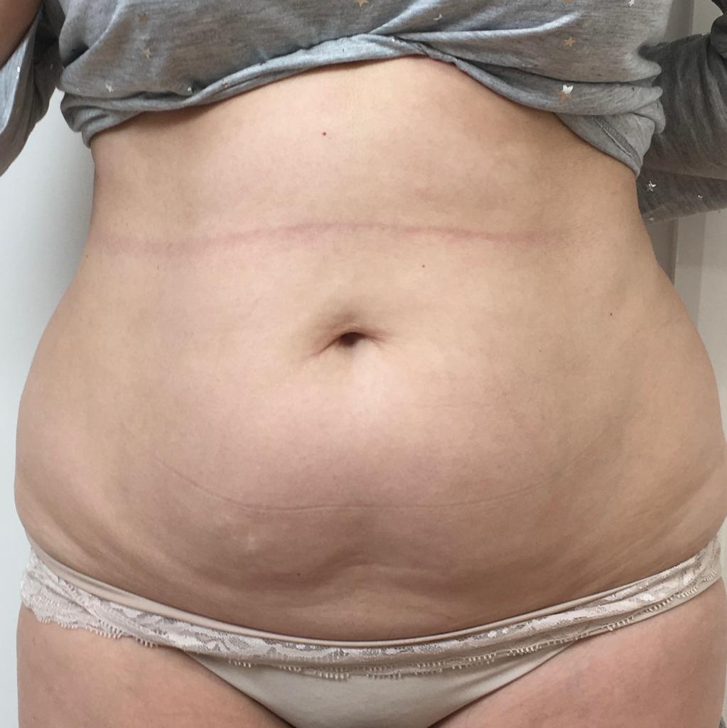 lipo-before